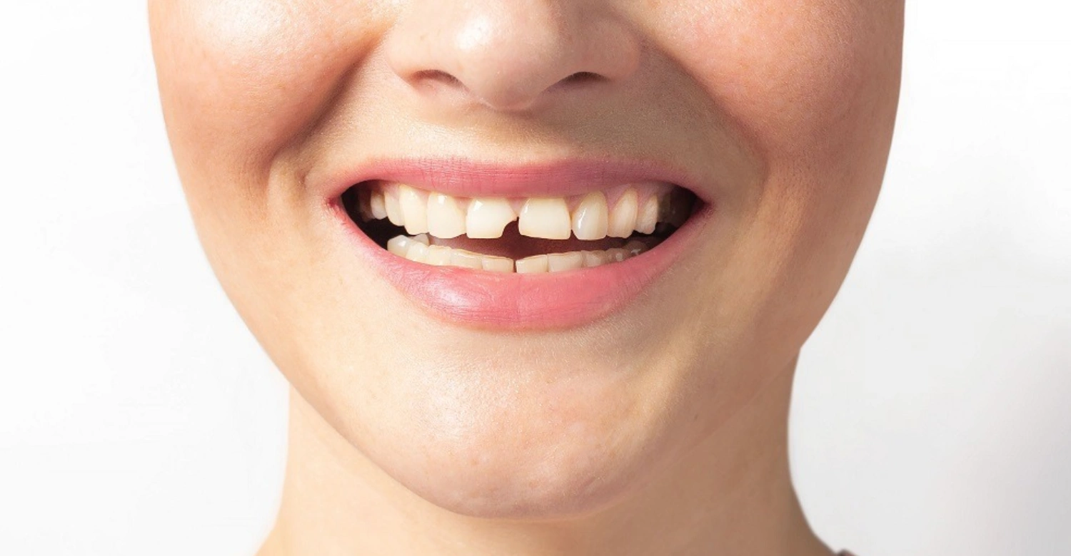Modern Methods for Repairing Chipped Teeth Inblog